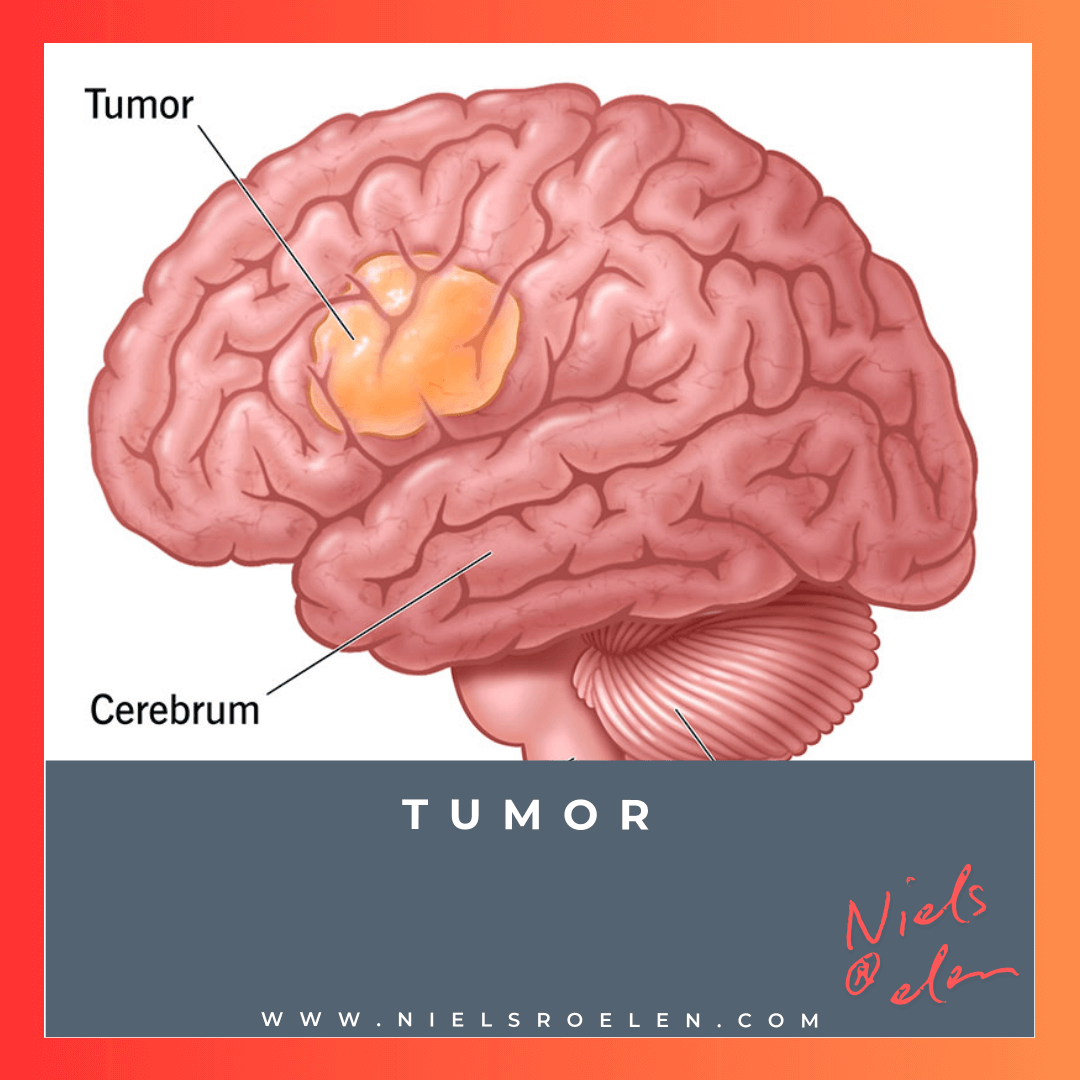 Tumor plaatje bij blog Niels Roelen